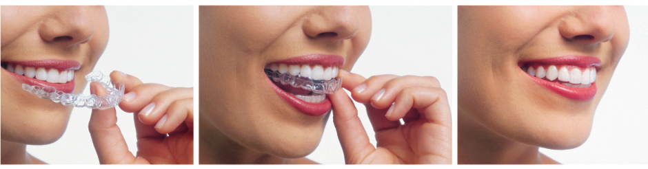 Lake City Family Dental Center | Oral Cancer Screening, Emergency Treatment and Teeth Whitening