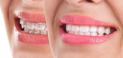 Lake City Family Dental Center | Dental Bridges, Emergency Treatment and Teeth Whitening