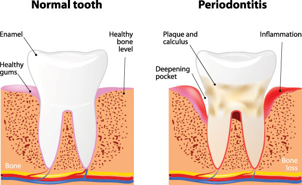 Lake City Family Dental Center | Emergency Treatment, Preventative Program and Teeth Whitening