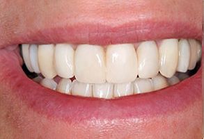 Lake City Family Dental Center | Teeth Whitening, Preventative Program and Cosmetic Dentistry